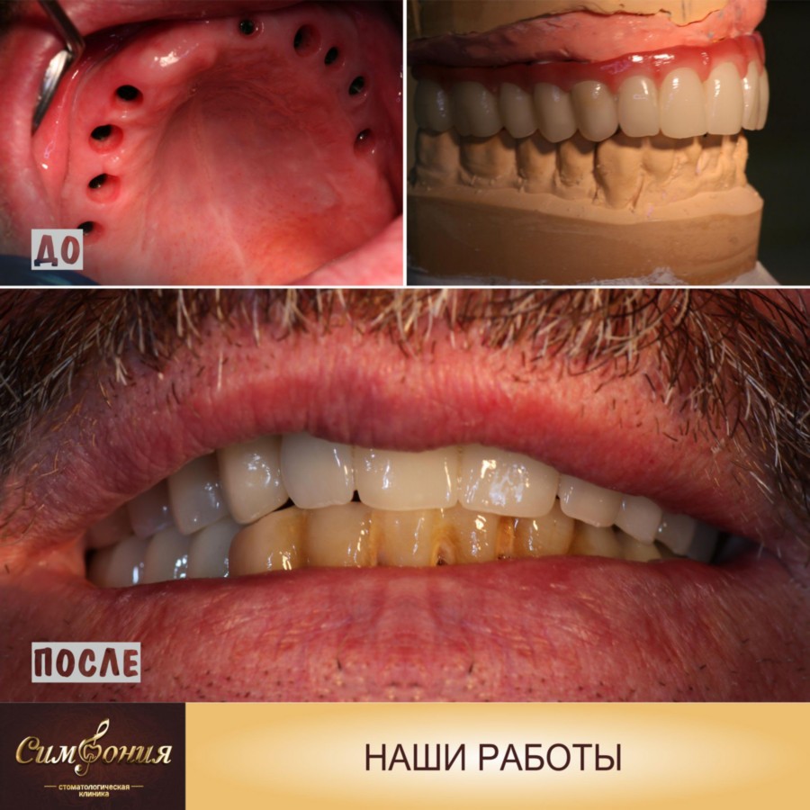 Виниры на огнеупорной модели, Фото зубов до и после, стоматология Кубани Симфония